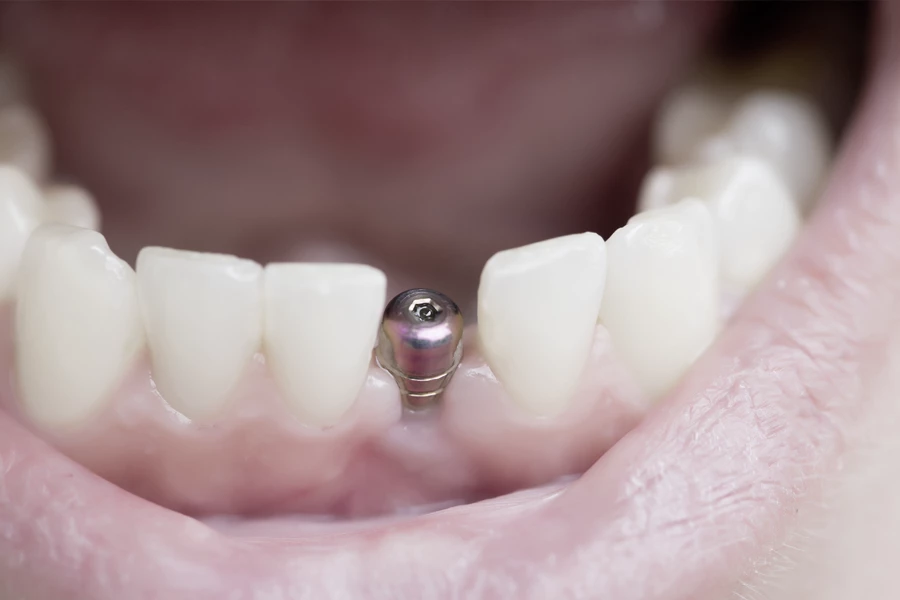 <span>Implantologie: Fühlt sich an wie der eigene Zahn. </span>Und sieht auch so aus.